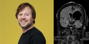 A photo of Ben looking into the camera, paired with a scan of his brain after stroke