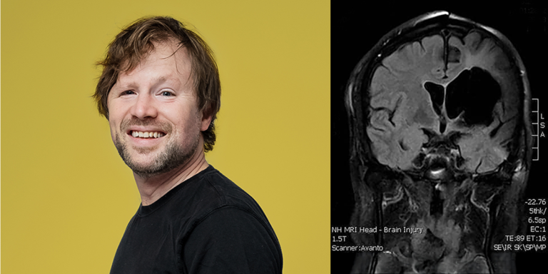 A photo of Ben looking into the camera, paired with a scan of his brain after stroke